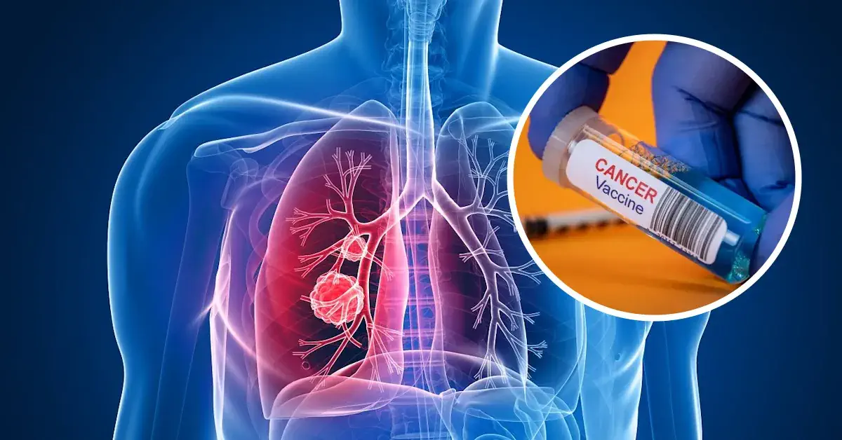 UK Developing Worlds First Lung Cancer Vaccine LungVax